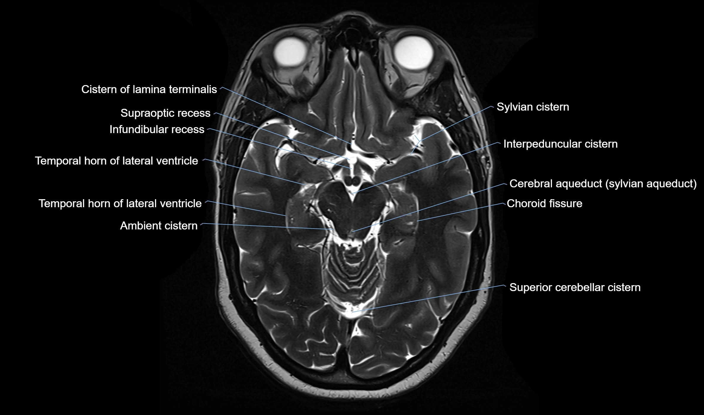 Brain cisterns  and ventricles  axial anatomy 3T MRI image-img-00001-00022.webp